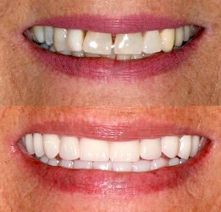 Implant-Supported Hybrid Dentures